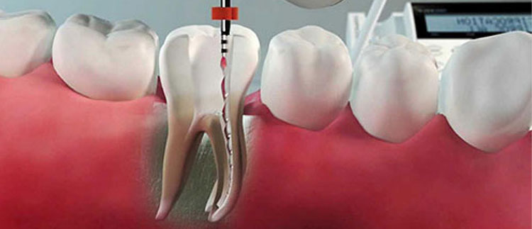 Root Canal Treatment In Coimbatore