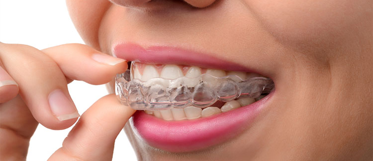 Invisible braces in Coimbatore